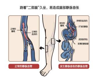 靜脈曲張有哪些癥狀